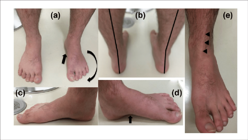 Preoperative Macroscopic Findings - Barefoot (850x483), Png Download