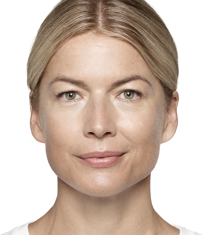 See Where Restylane® Products Can Help Reduce Your - Restylane (696x804), Png Download