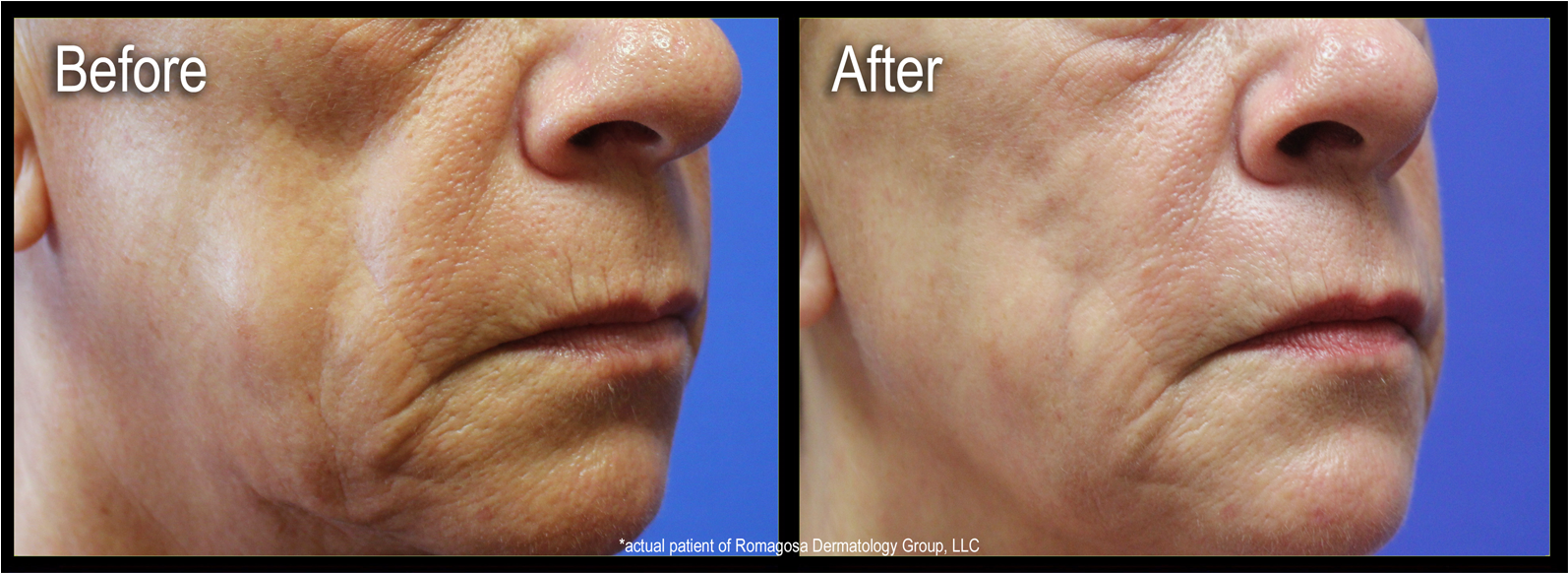 Are Injectable Gels Used To Restore Fullness And Volume - Scar (1600x700), Png Download