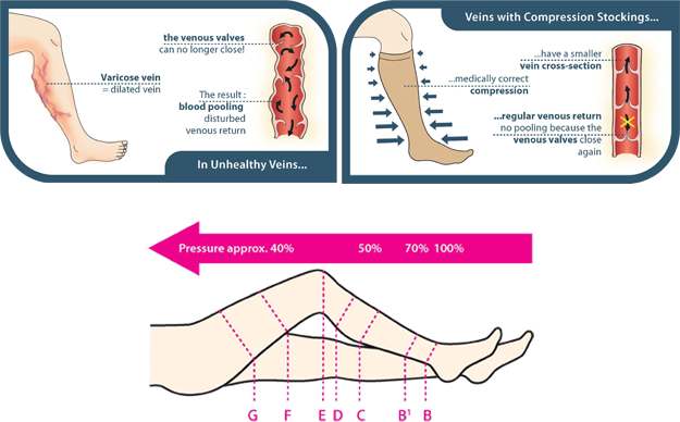 Traditionally, Patients With Varicose Veins Were Recommended - Conservative Treatment Of Varicose Veins (625x388), Png Download