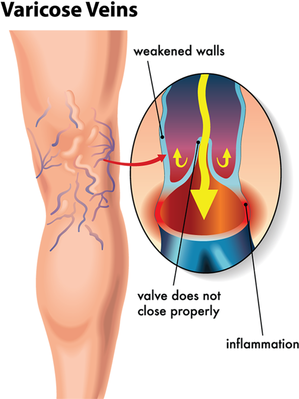 By Unsightly Veins Are Delighted With The Results They - Varicose Veins Diagram (600x800), Png Download