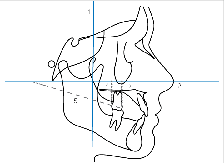 Lines Demarcated On The Lateral Teleradiograph - Line Art (717x522), Png Download