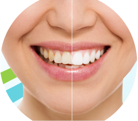 Teeth Whitening - Restorations Teeth (445x390), Png Download
