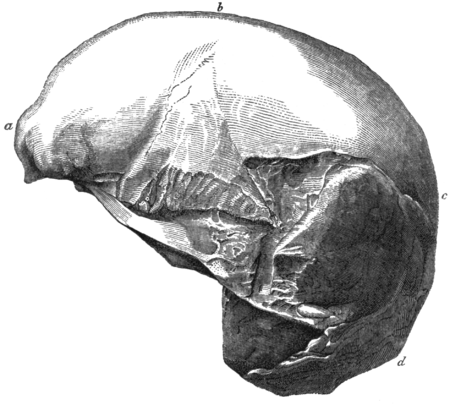 Side View Of The Cast Of Part Of A Human Skull Found - Clip Art (450x405), Png Download