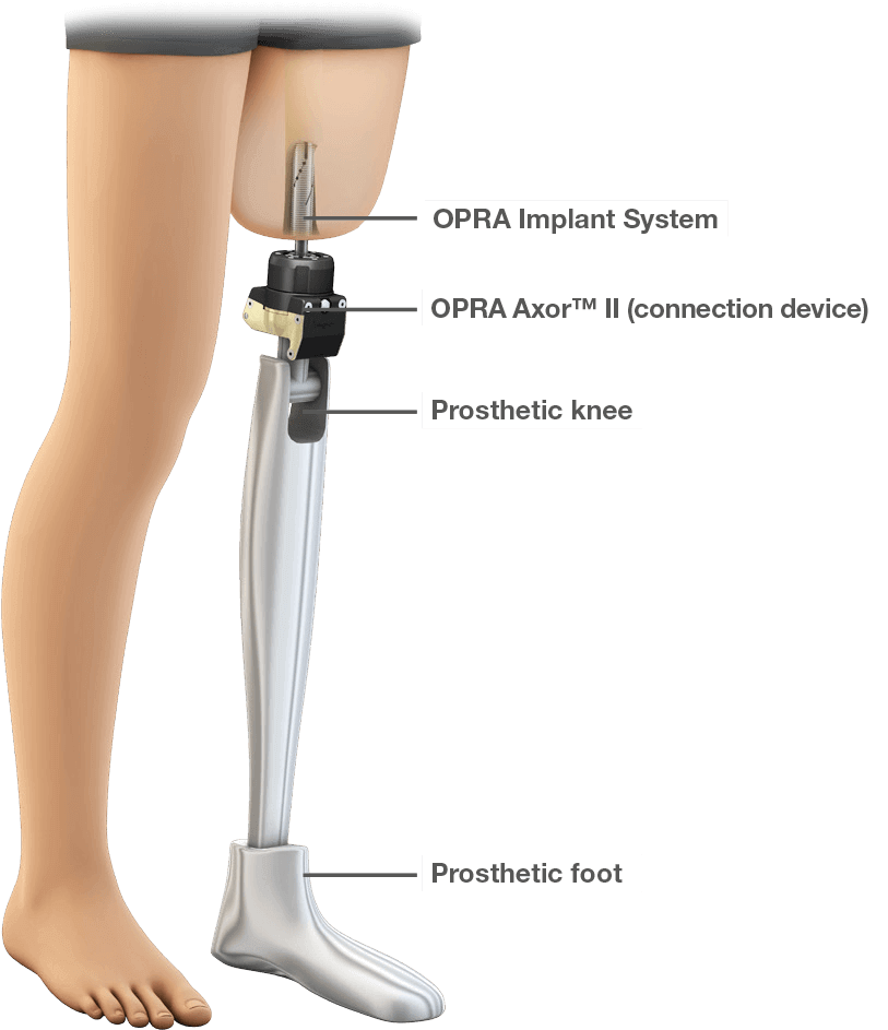 Popular Images - Amputation Prosthesis (816x952), Png Download