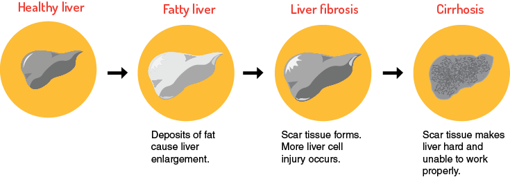 Causes - Fatty Liver Disease (735x256), Png Download