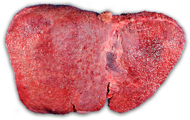 The Progression Of Liver Disease - Wilson Disease (707x452), Png Download