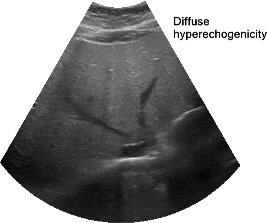 Fatty Liver - Miniskirt (1080x754), Png Download