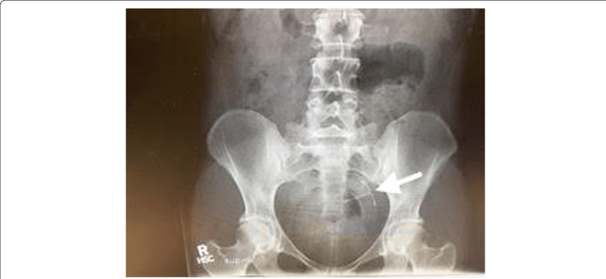 Abdominal Radiograph Of Pelvis With Arrow Pointing - X-ray (850x392), Png Download