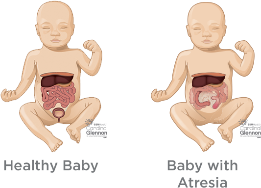 How Is It Managed And Treated During Pregnancy - Congenital Diaphragmatic Hernia (620x520), Png Download