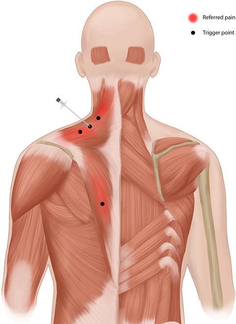 Trigger-pain - Trigger Points Injections (520x673), Png Download