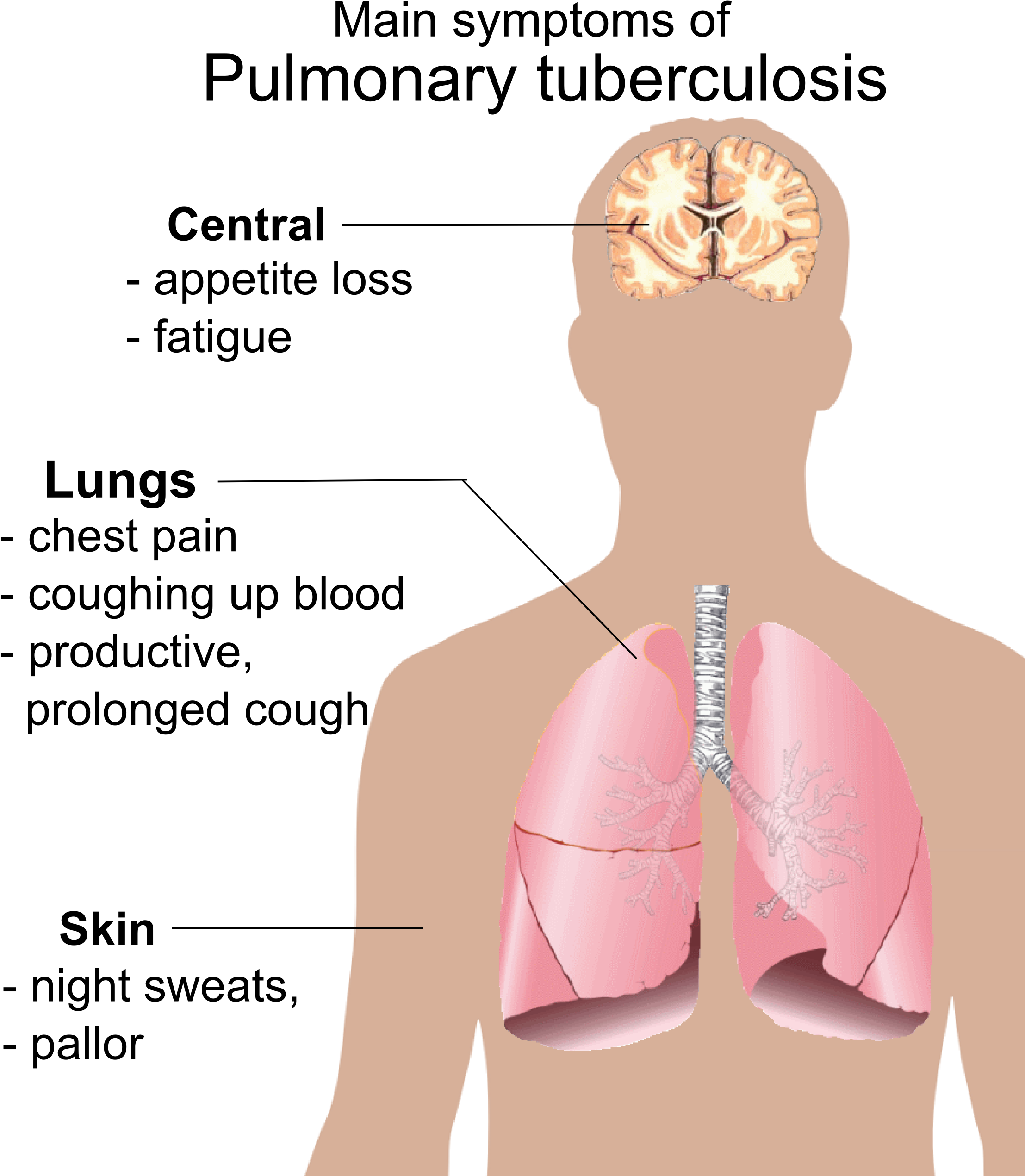 Pulmonary Tuberculosis Symptoms - Symptoms Of Aids (2244x2569), Png Download