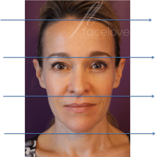 Lower Face Rejuvenation At Facelove - Can Cheek Filler Lift Jowls (519x521), Png Download
