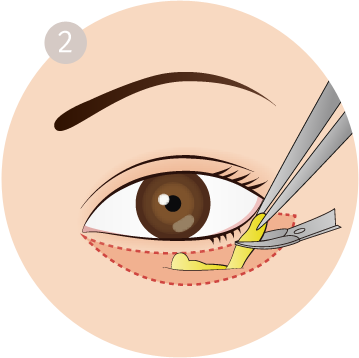 Royalty Free Stock Fresh Plastic Surgery Removes Saggy - Royalty-free (359x358), Png Download