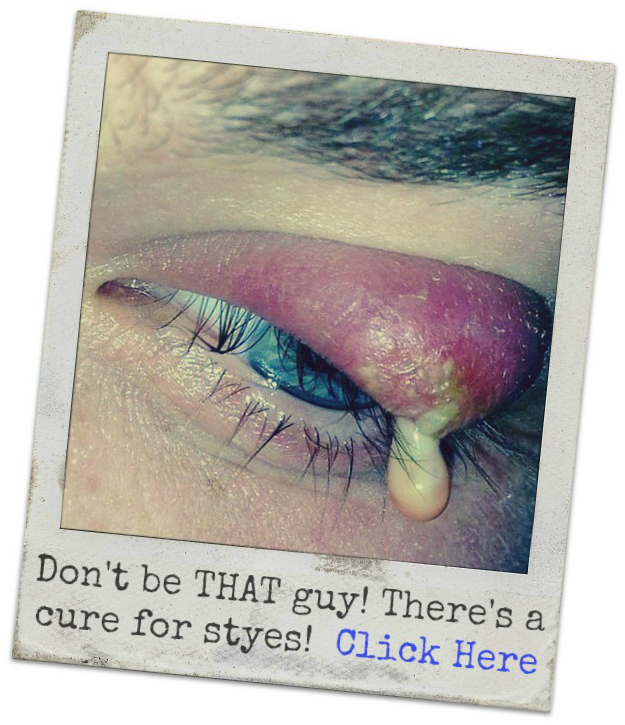 Eye Stye (625x725), Png Download