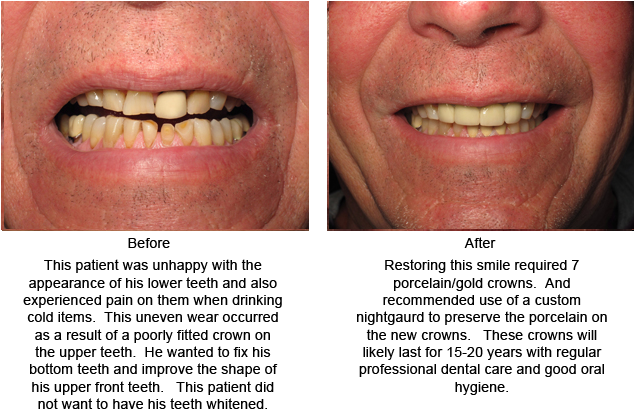 This Patient Desired A Brighter Smile In Minimum Time - Aggression (650x432), Png Download