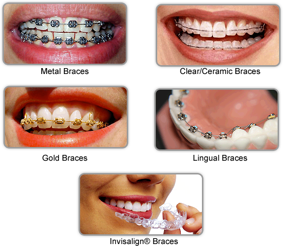 Clear Aligners (576x502), Png Download