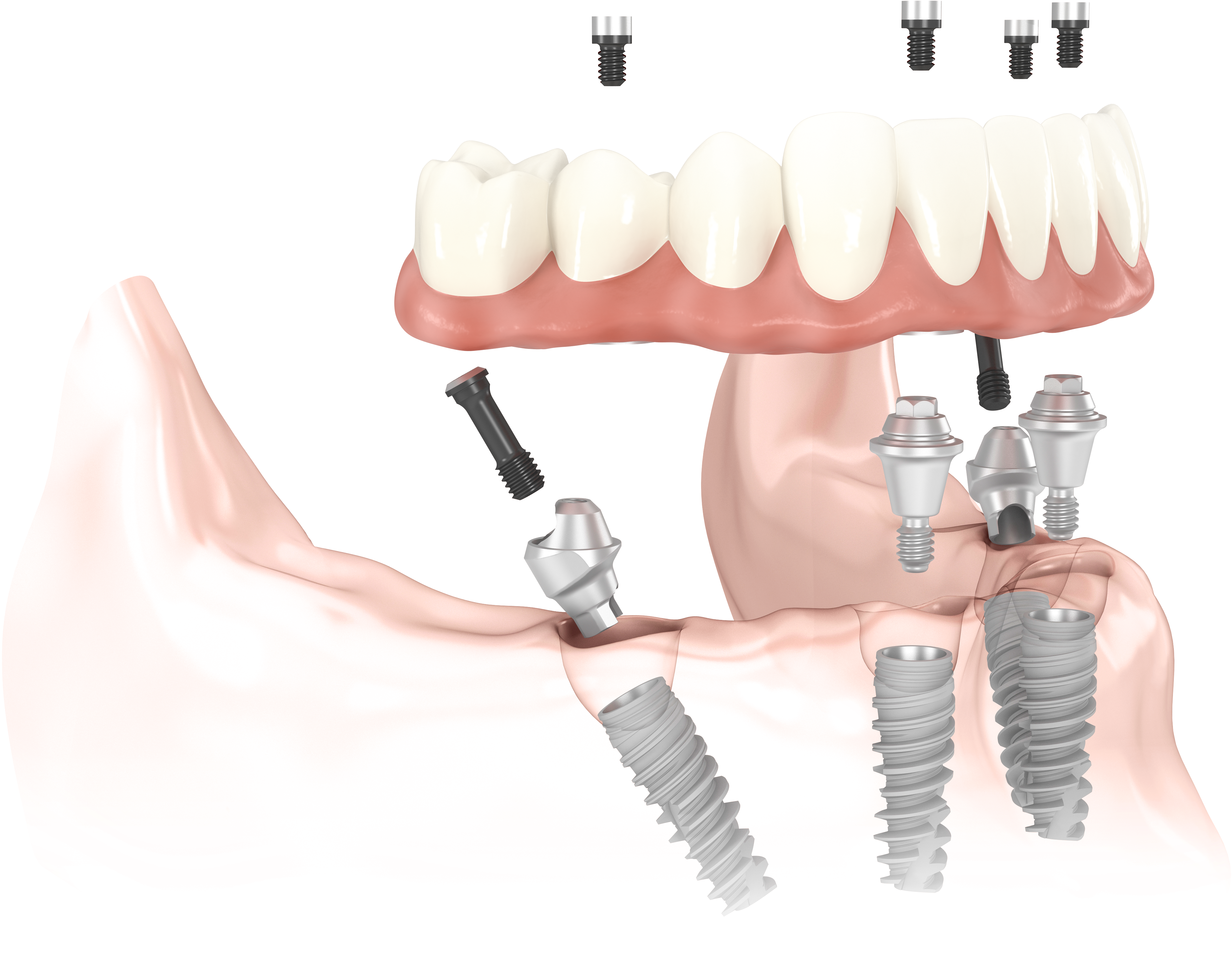 All On 4 Implants, Zygomatic Implants & Implant Dentures - All On 4 Implants (5000x3333), Png Download