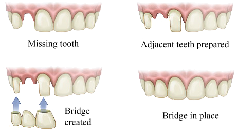 Service Img Bridge - Dental Bridge (460x285), Png Download