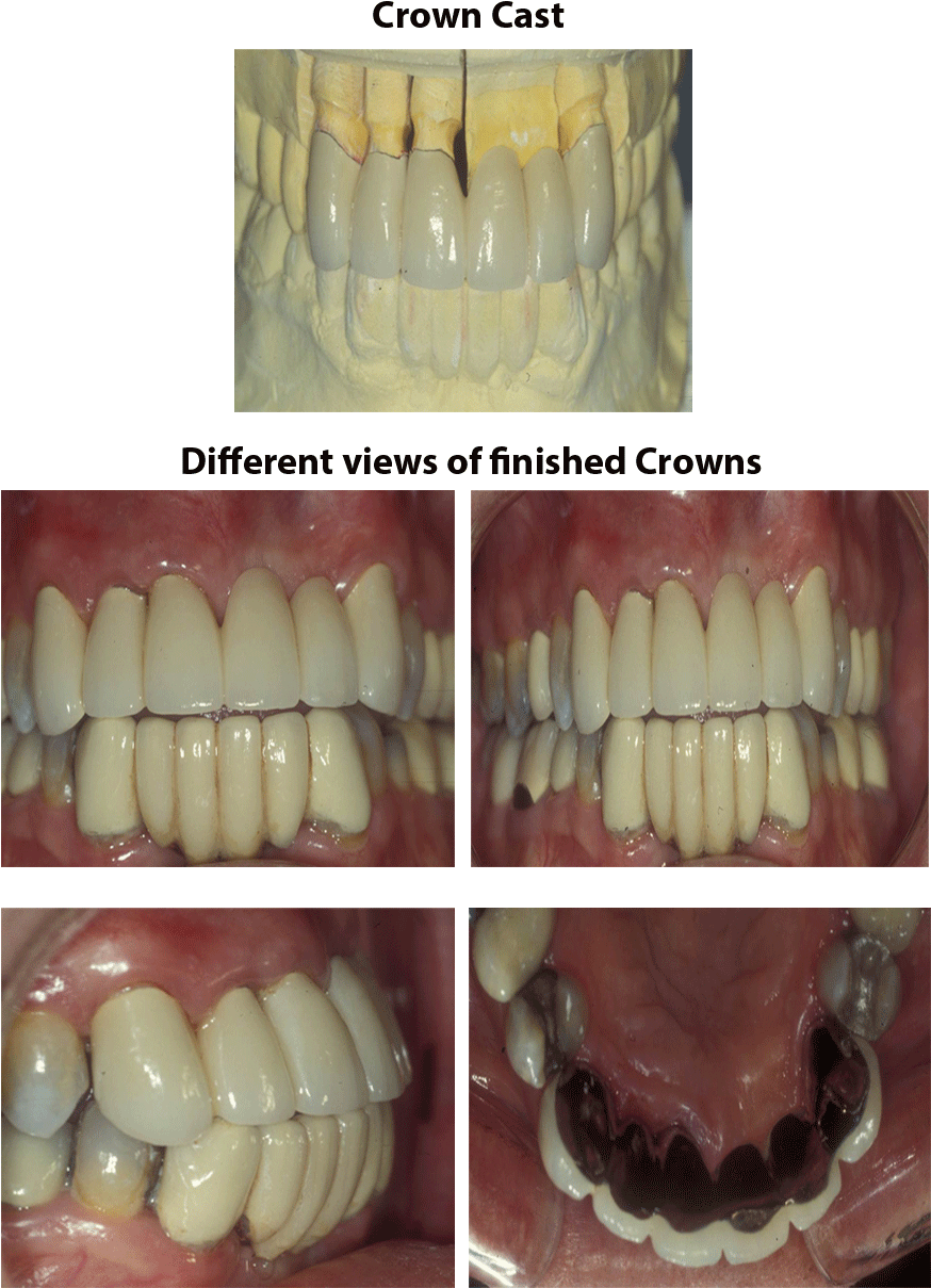 This Case Shows The Finished Bridge Of One Of Our Patients - Washington, D.c. (900x1320), Png Download