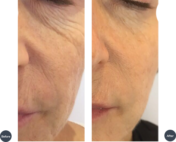 Treatment Of Skin Texture And Rejuvenation - Scar (591x475), Png Download