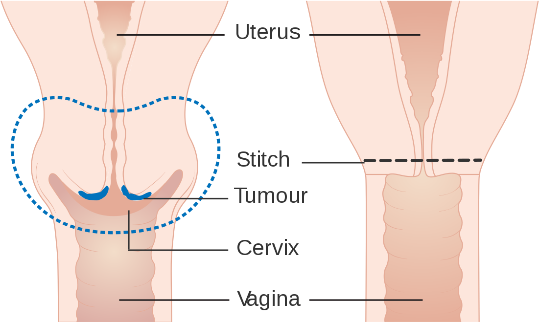 Removal Of Cervix Surgery (1200x819), Png Download