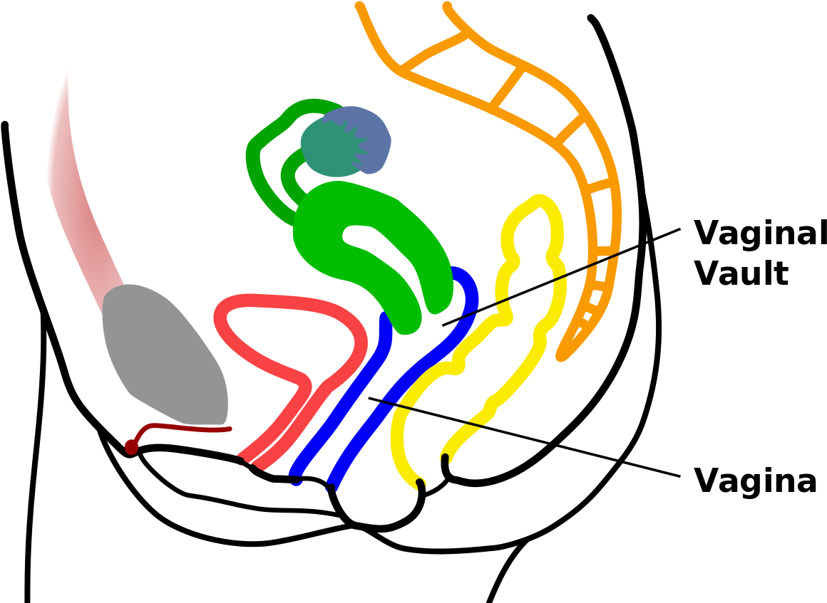 Vaginal Vault (1200x849), Png Download