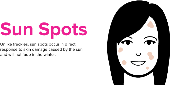 Because Of This, One Of The Best Ways To Reduce The - Freckles Caused By Sun (800x400), Png Download