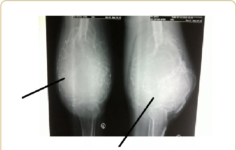 Ap And (b) Lateral Radiographs Of The Left Knee Joint - Osteolytic Lesion (769x489), Png Download