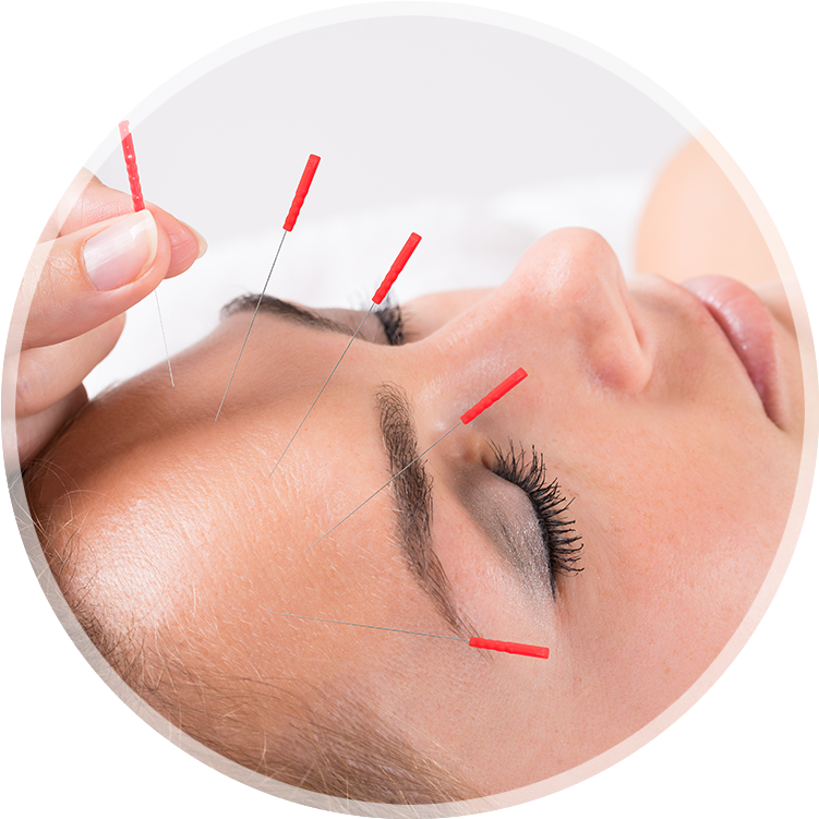 Louisville Acupuncture Treatment - Acupuncture Migraine (800x800), Png Download