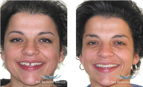 Prevnext - 6 Month Smiles Gaps (553x323), Png Download