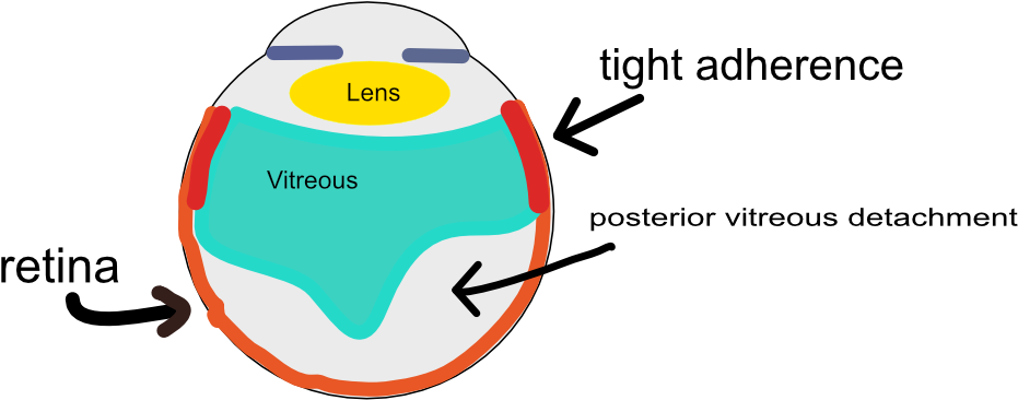 During The Process Of A Pvd, The Vitreous Rapidly Peels - Light Probe In Eye Surgery (993x450), Png Download