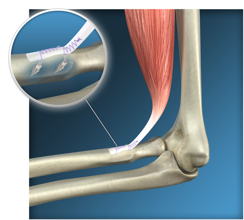 Endoscopic Distal Biceps Reinsertion Surgery, Toulouse - Rotura Del Tendon Distal Del Biceps (1000x896), Png Download