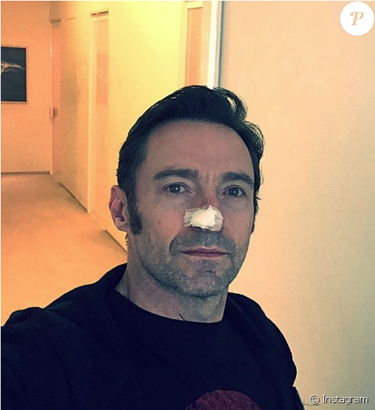 Hugh Jackman Après Une Nouvelle Opération Visant À - Michael Gracey Without Hat (950x596), Png Download