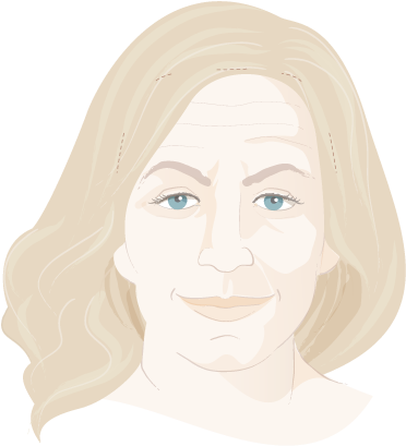 Graphic Showing Woman's Face Before Brow Lift - Visual Arts (400x426), Png Download