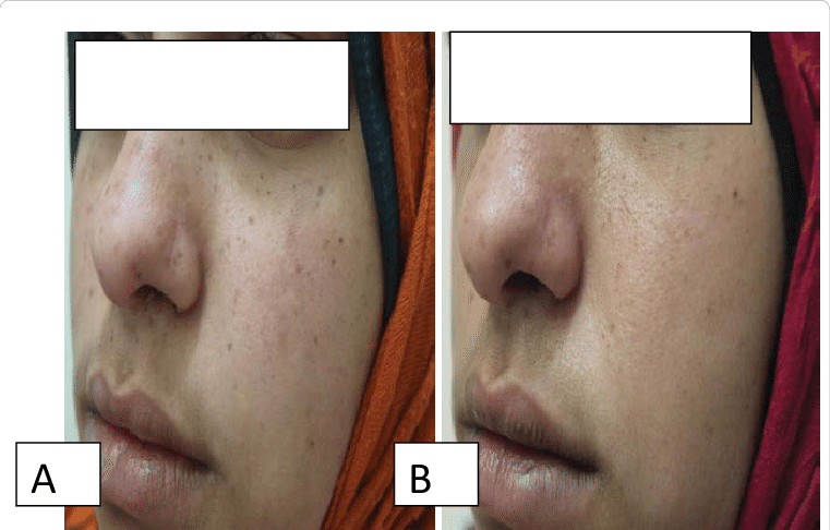 Female Patients 27 Years Old With Freckle Treated With - Q Switch Yag Laser For Freckles (761x486), Png Download