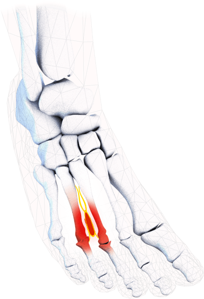 Morton's Neuroma - Radiography (720x600), Png Download