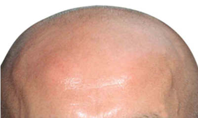 Baldhead - Hair Loss (400x300), Png Download