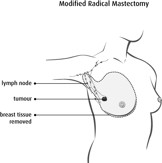 Diagram Of A Modified Radical Mastectomy - Muscle Between Boob And Armpit (524x526), Png Download