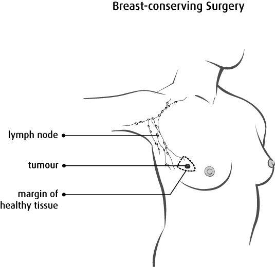 Diagram Of Breast Conserving Surgery - Surgery In Breast Cancer (535x520), Png Download