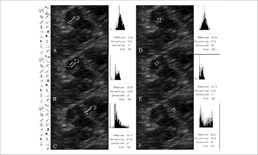 Data Obtained By Computer-aided Quantification Of Echogenicity - River (850x511), Png Download