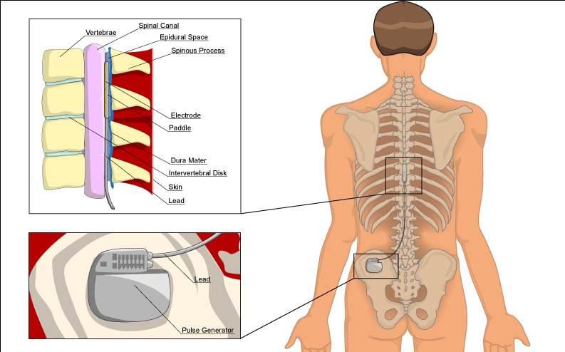 Spinal Cord Stimulation - Spinal Stimulation Pain (793x494), Png Download