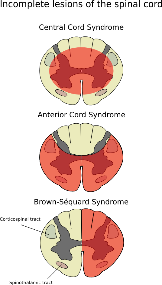 File - Cord-en - Anterior Spinal Syndrome (536x938), Png Download