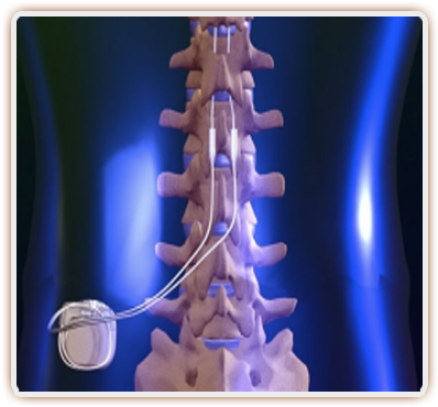 In A Lot Of Post-laminectomy Cases, A Spinal Cord Stimulator - Spinal Cord Stimulators (400x400), Png Download