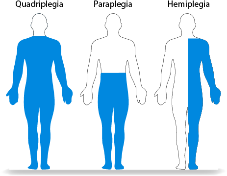 Conventional Method To Treat A Spinal Cord Injury - Paraplegia Quadriplegia And Hemiplegia (502x396), Png Download