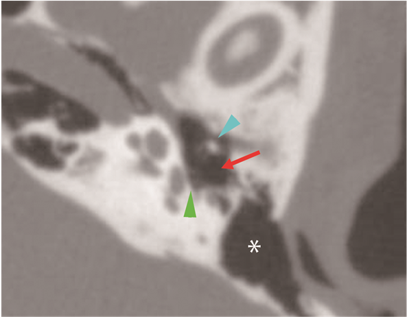 High-resolution Computed Tomography Revealed An Ambiguous - Computed Tomography (903x461), Png Download