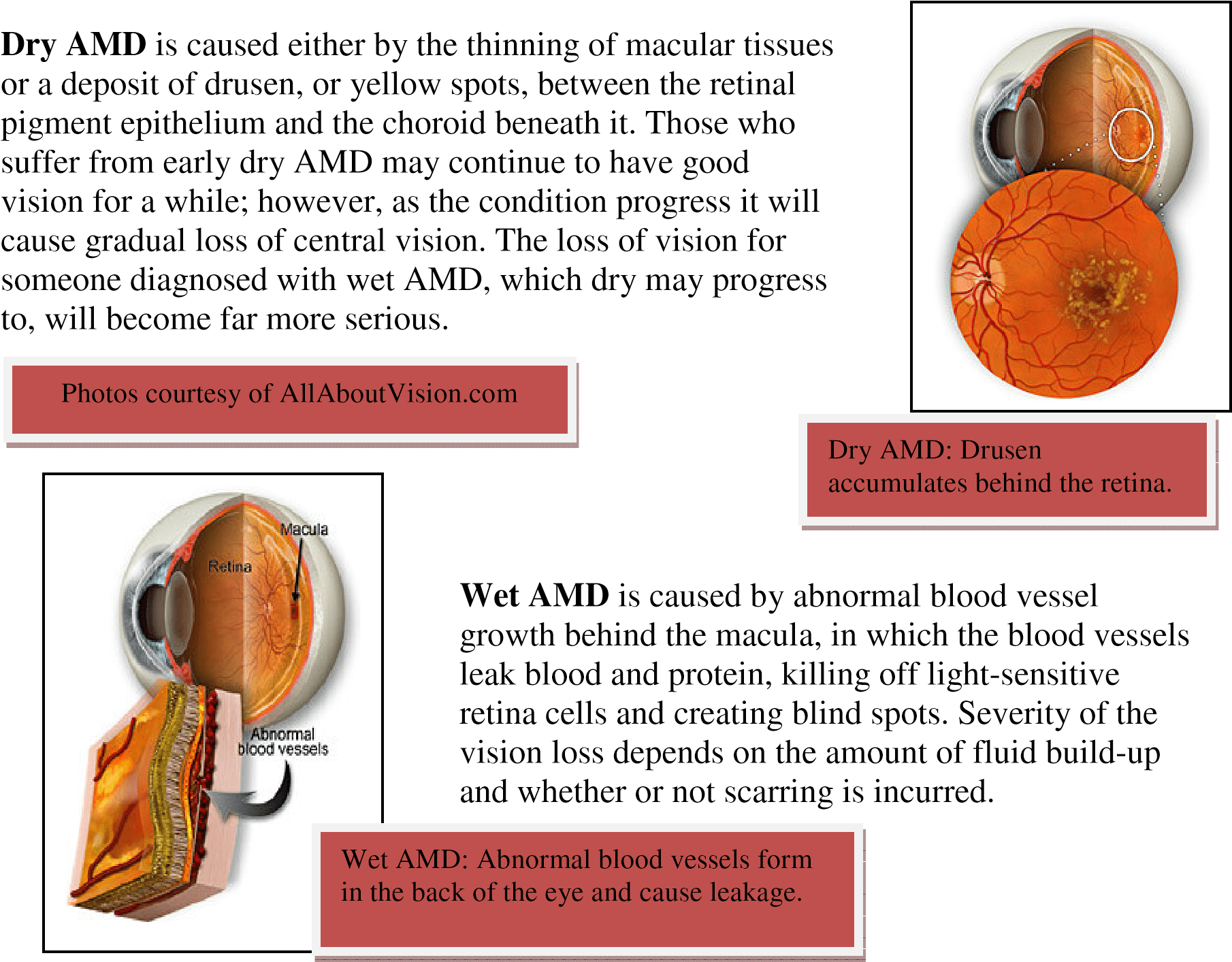 Eyeball Chart - Age Related Macular Degeneration (1810x1413), Png Download