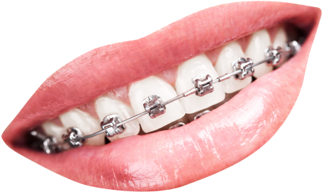 Teeth With Braces Png Transparent Image - Teeth Braces Png (500x368), Png Download