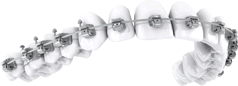 Why Braces - Orthodontic Brackets Png (800x291), Png Download