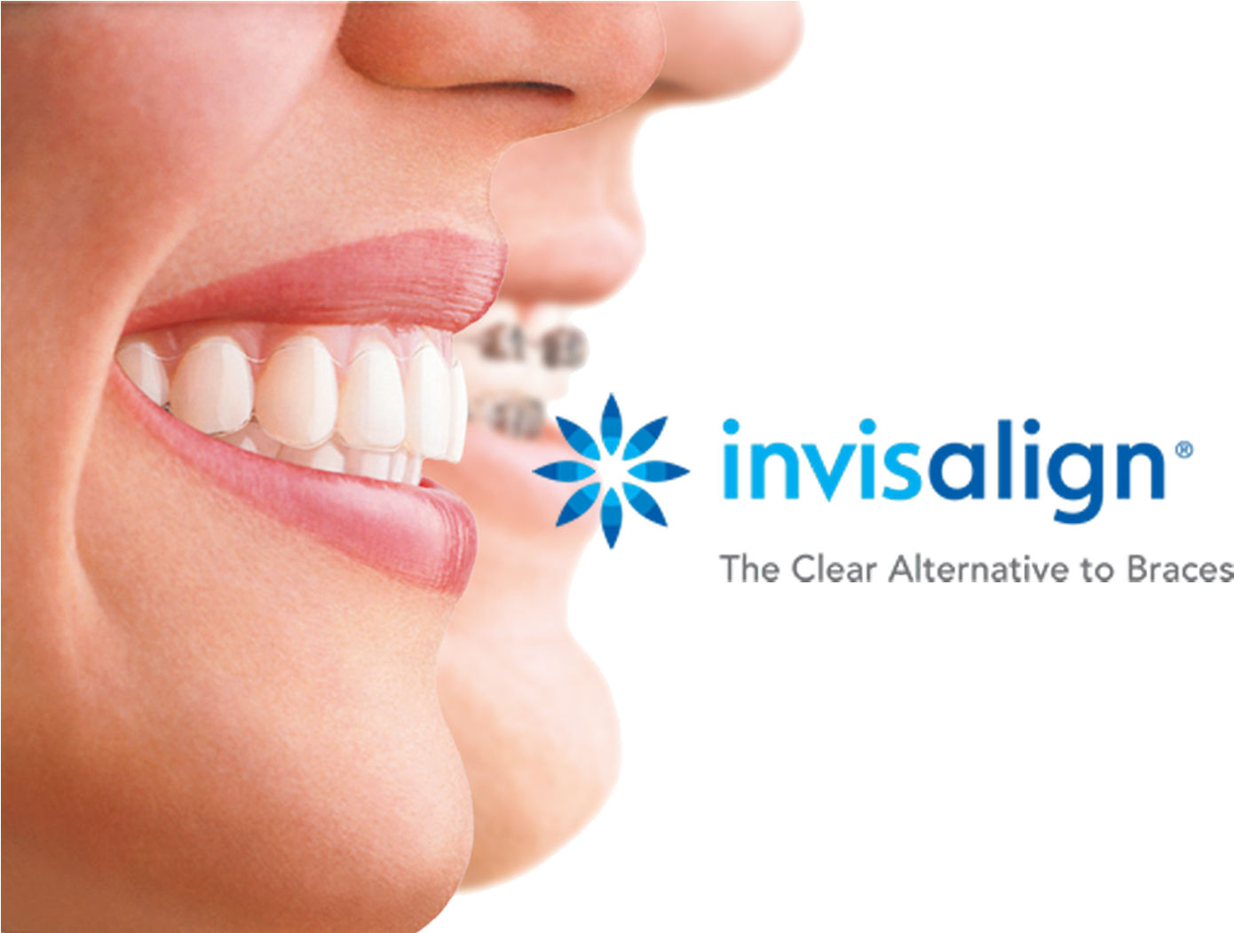 Download Cdn2 Hubspot Clear Aligners Png Image With No Background Pngkey Com